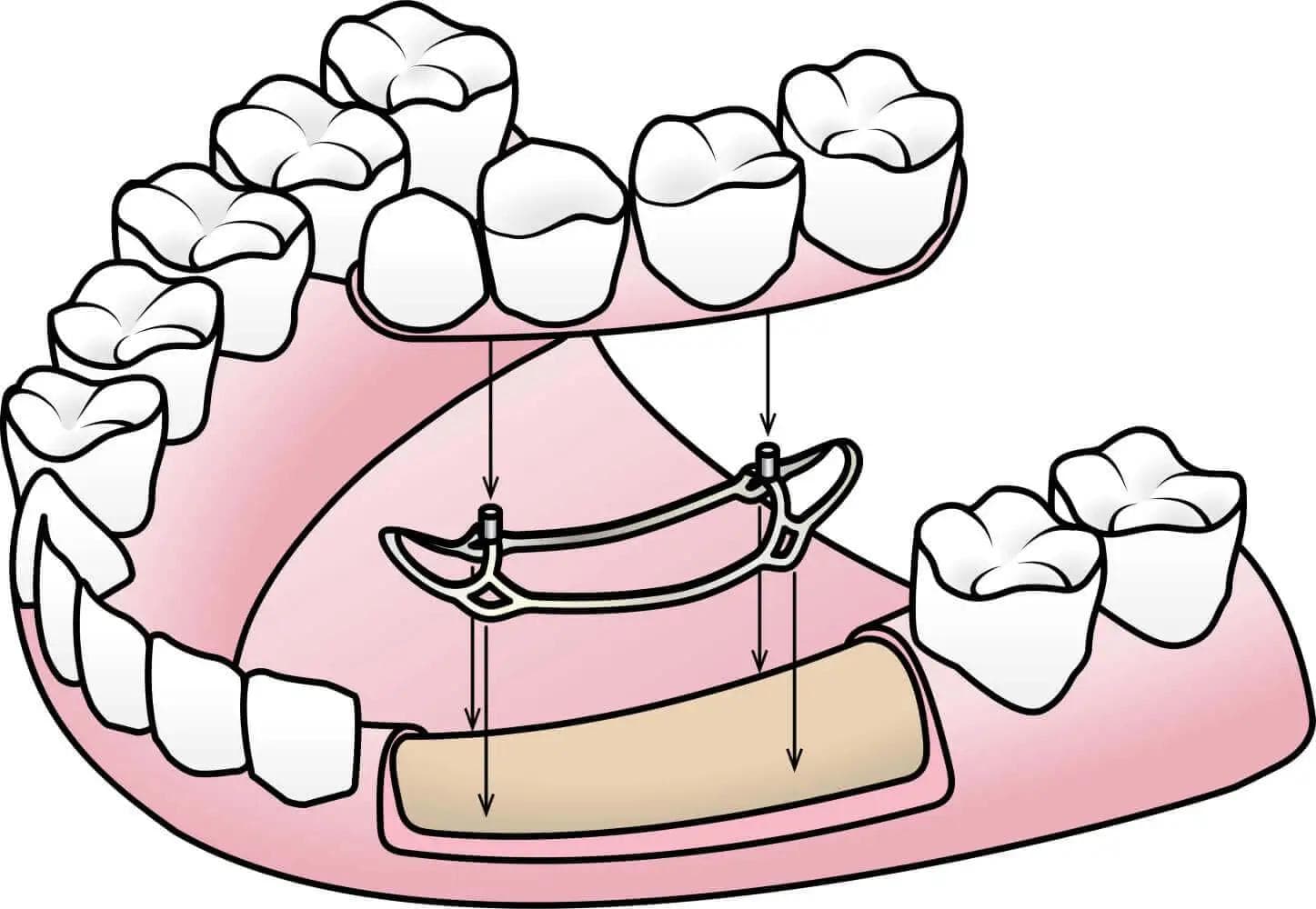 Illustration of subperiosteal dental implants