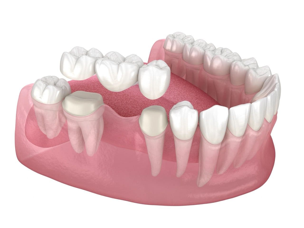 3D rendering of a traditional dental bridge