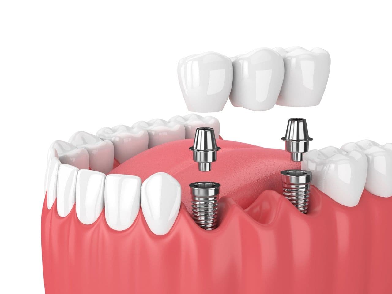 3D render of an implant-supported bridge