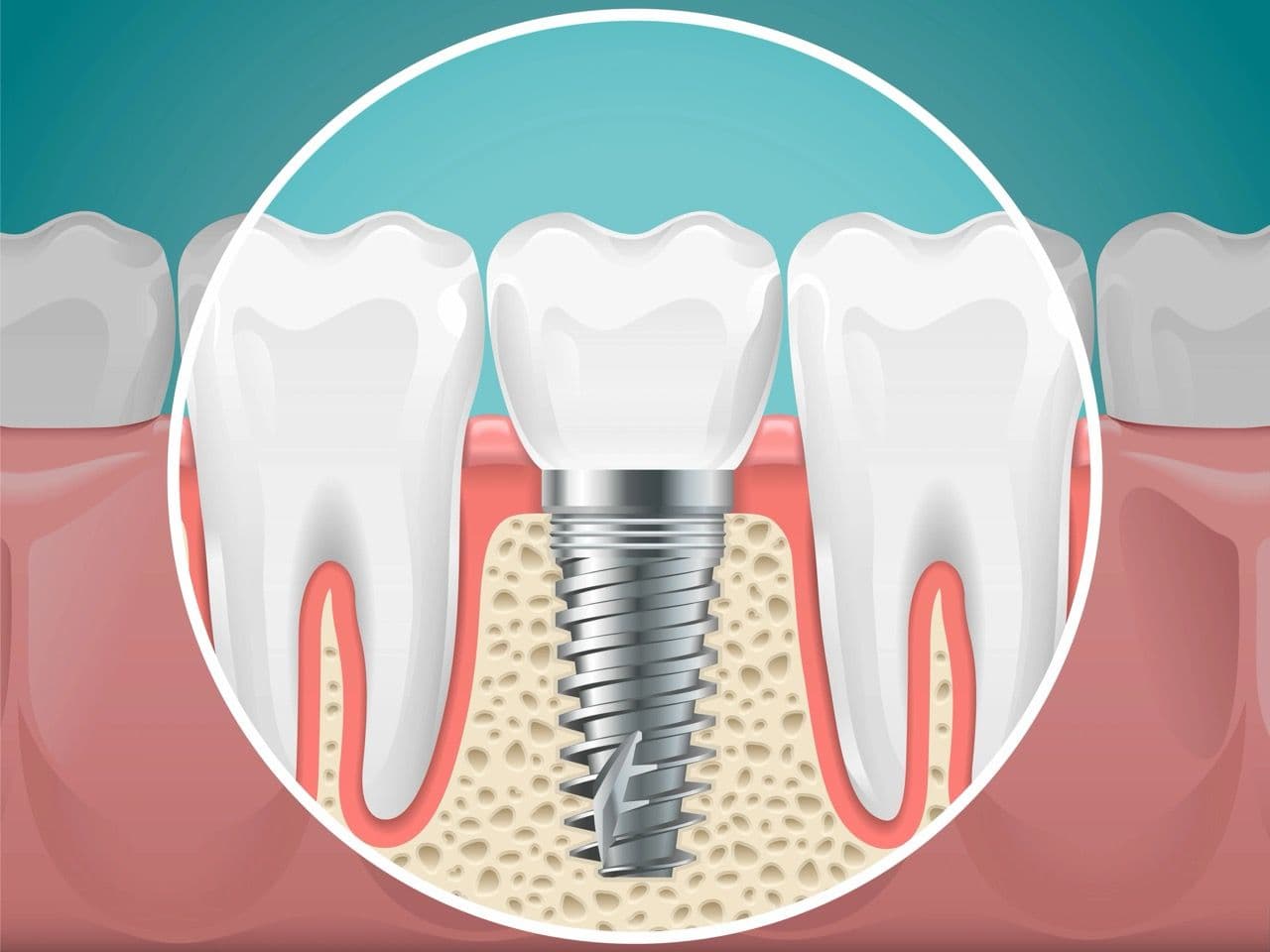 Illustration of a dental implant installed in a jawbone