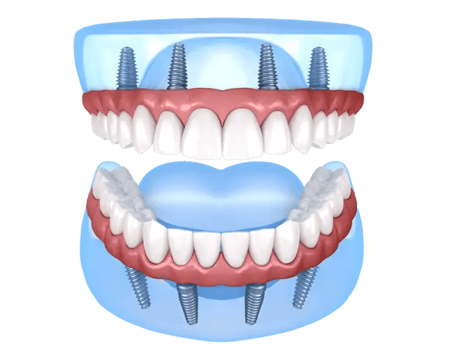 Illustration of All-In-One dental implant solution