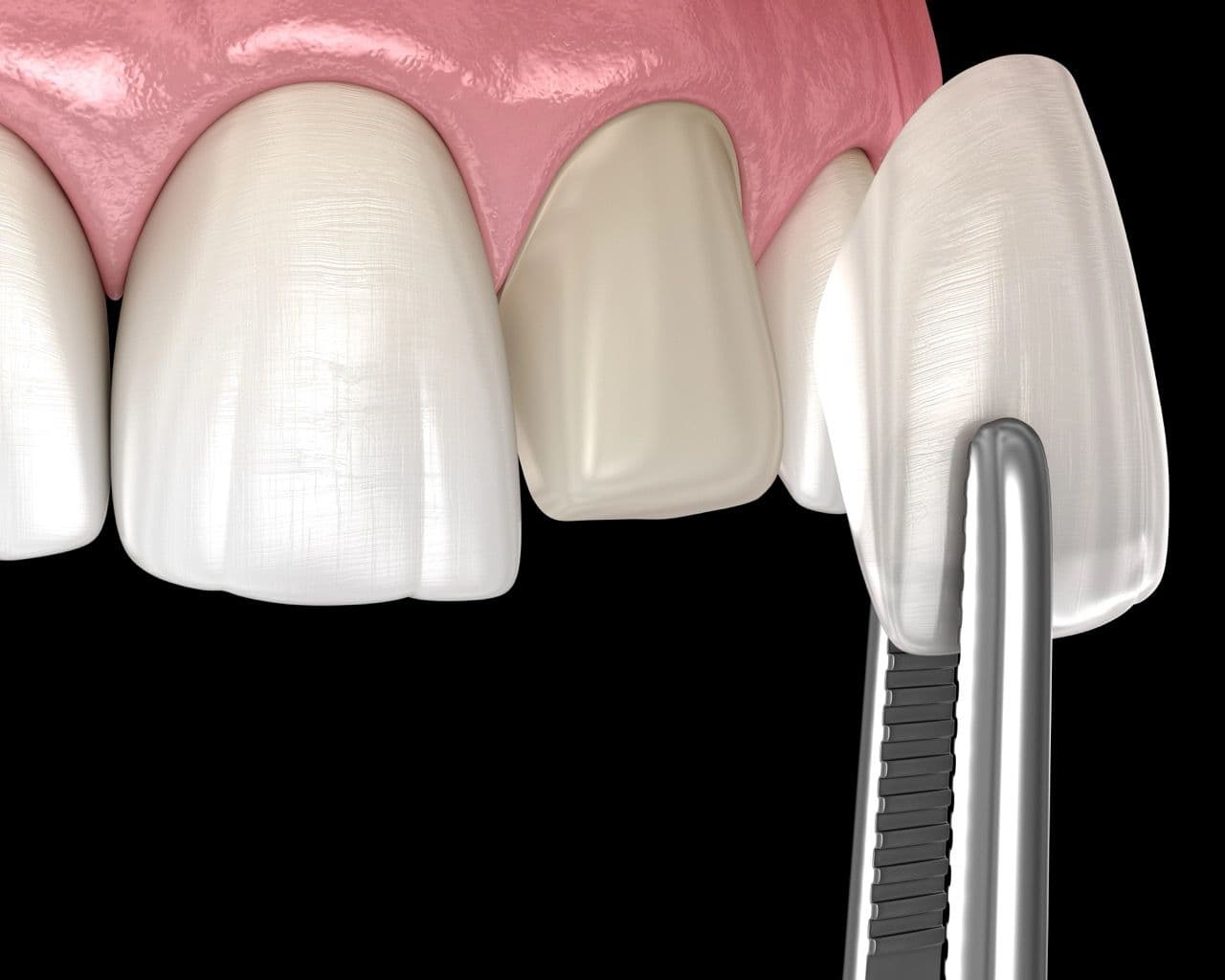 3D render of a veneer being placed on a tooth