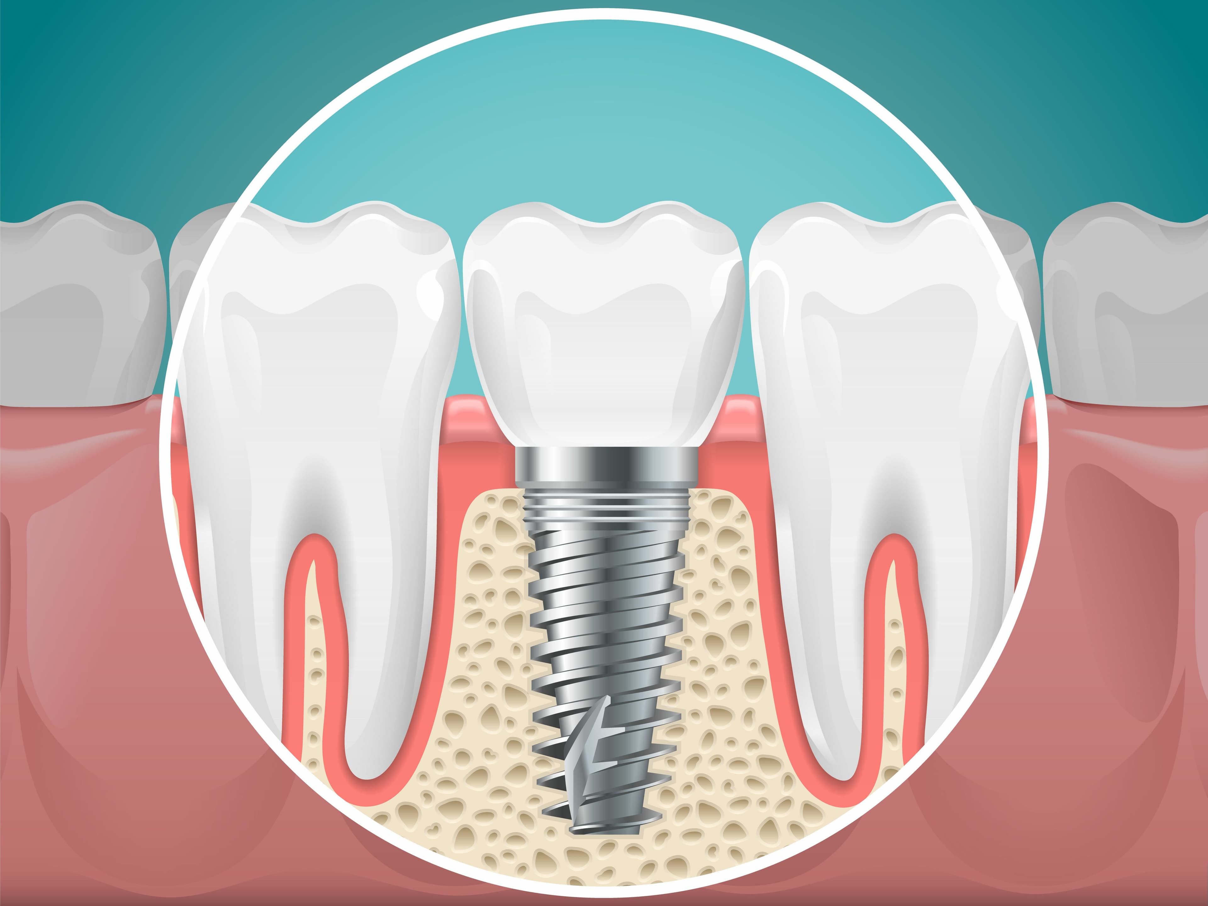 Dental Implants: The Best Permanent Tooth Replacement Option | Affordable Dentures & Implants