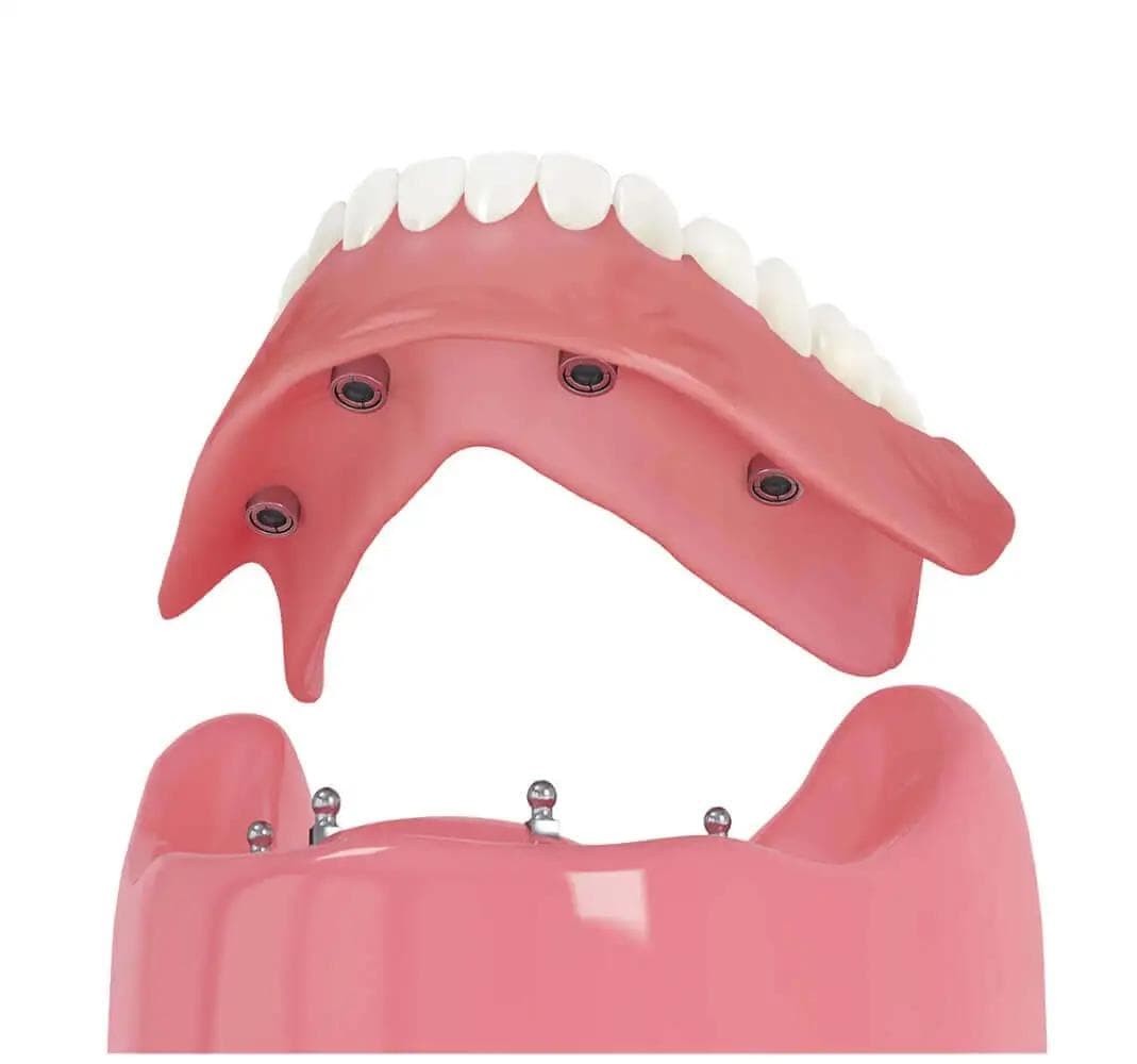 3D rendering of mini dental implants