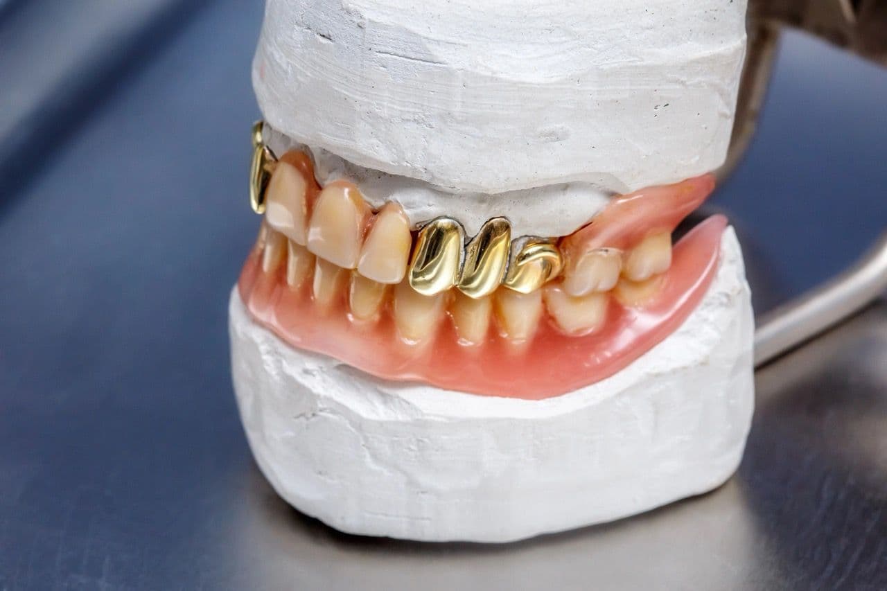 Photo of a denture with multiple gold teeth in a mold.
