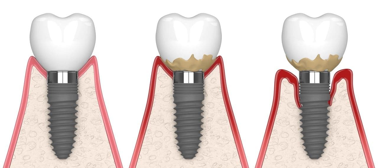 Illustration showing three implants, one healthy and two problematic.