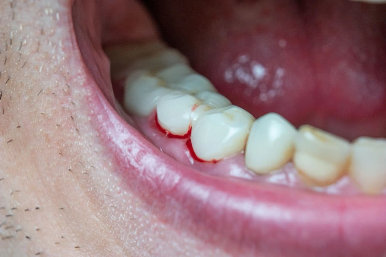 Photo of an open mouth with bleeding around the tooth and gums.
