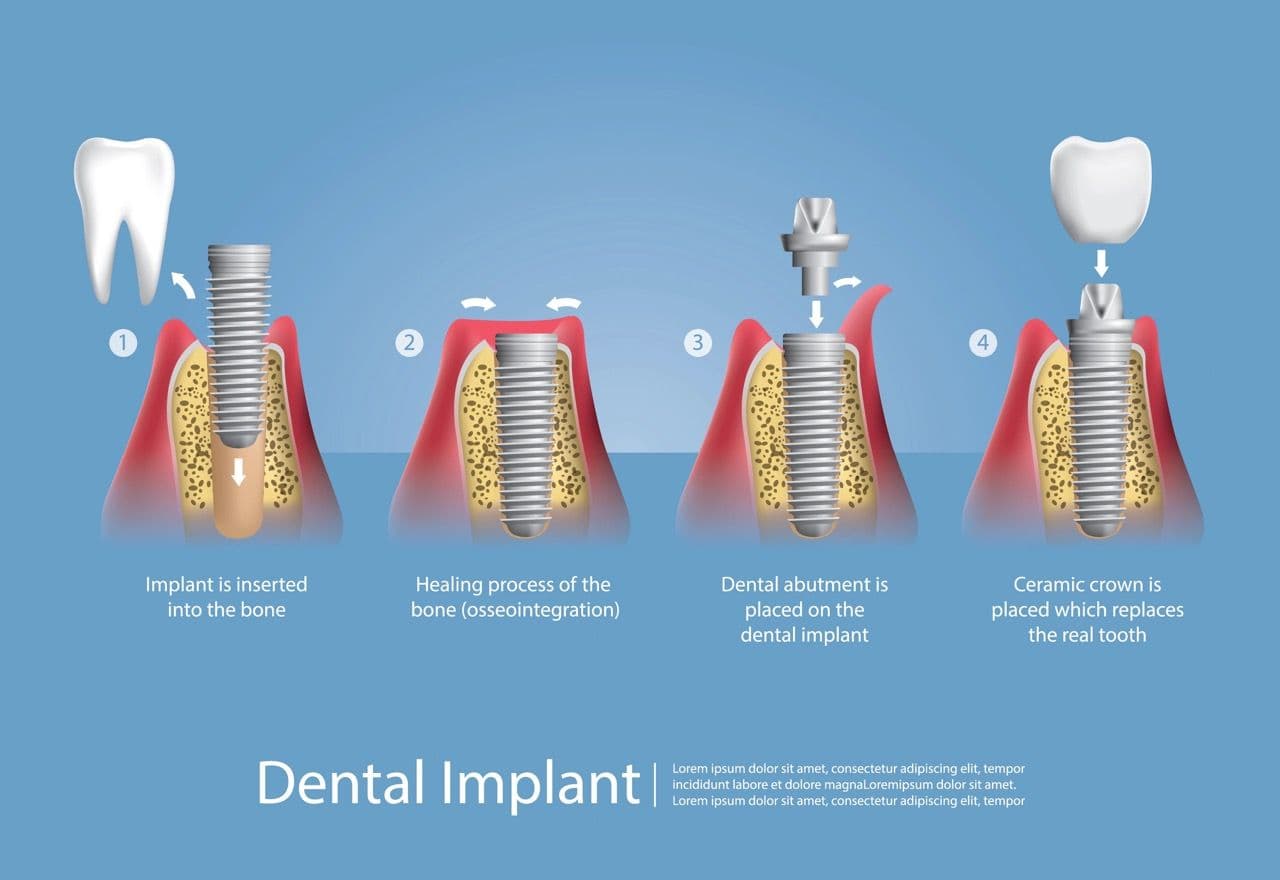 3D Illustration of the process of dental implantation