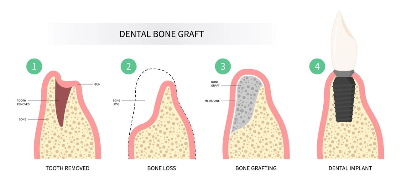 Illustration of a dental bone graft.