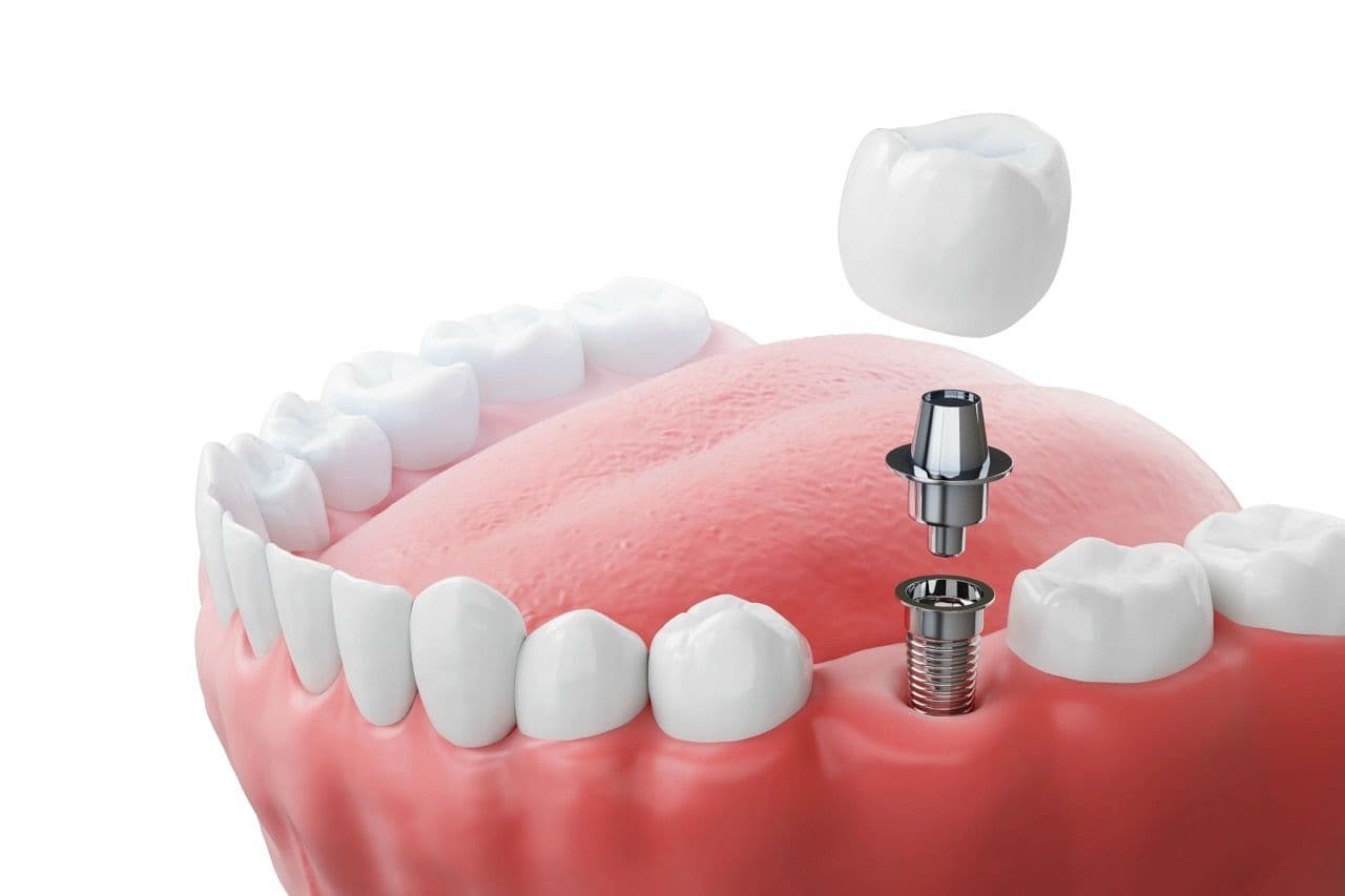 Close-up of a dental implant and crown in a mouth