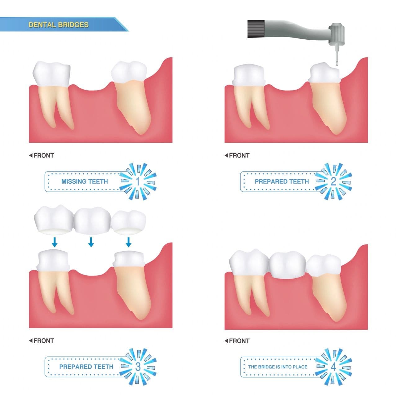 Illustration of the four dental bridges in place in a mouth