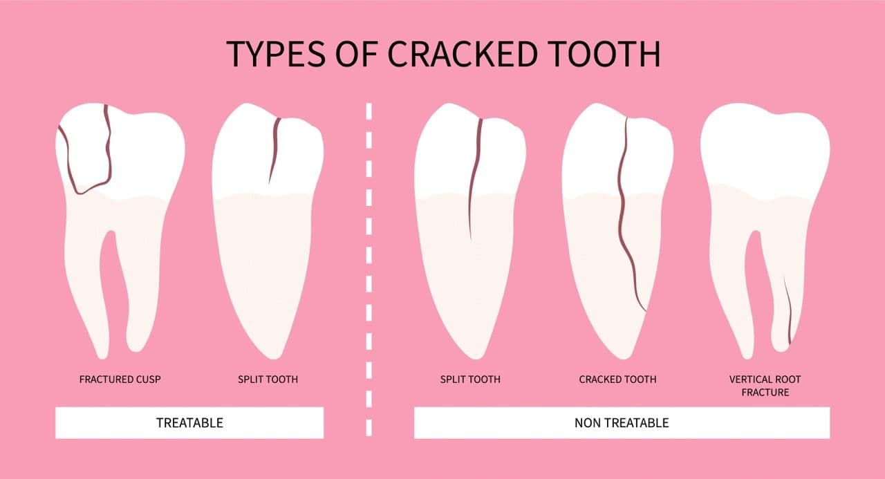 Illustration of cracked teeth showing what is treatable and not treatable.