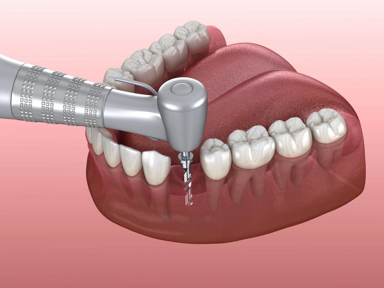 3D render of a dental drill preparing an implant