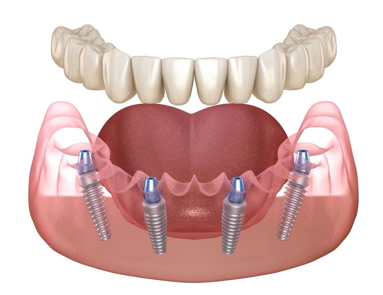 3D render of dental implants installed in a lower jaw