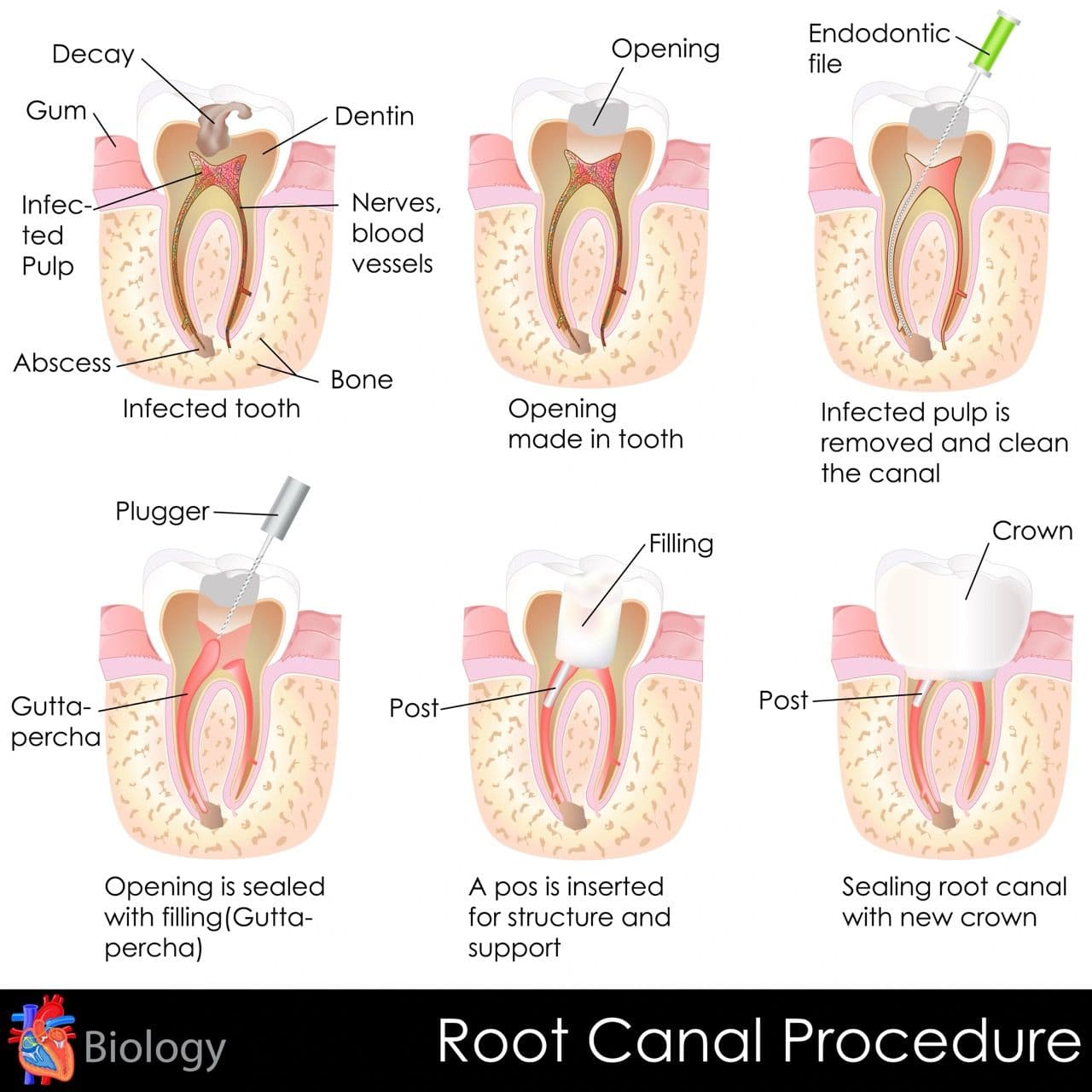 Illustration showing six steps of a root canal procedure
