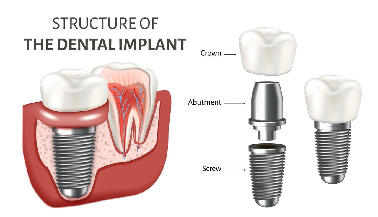 Illustration of the parts of a dental implant: Crown, Abutment, and Screw.