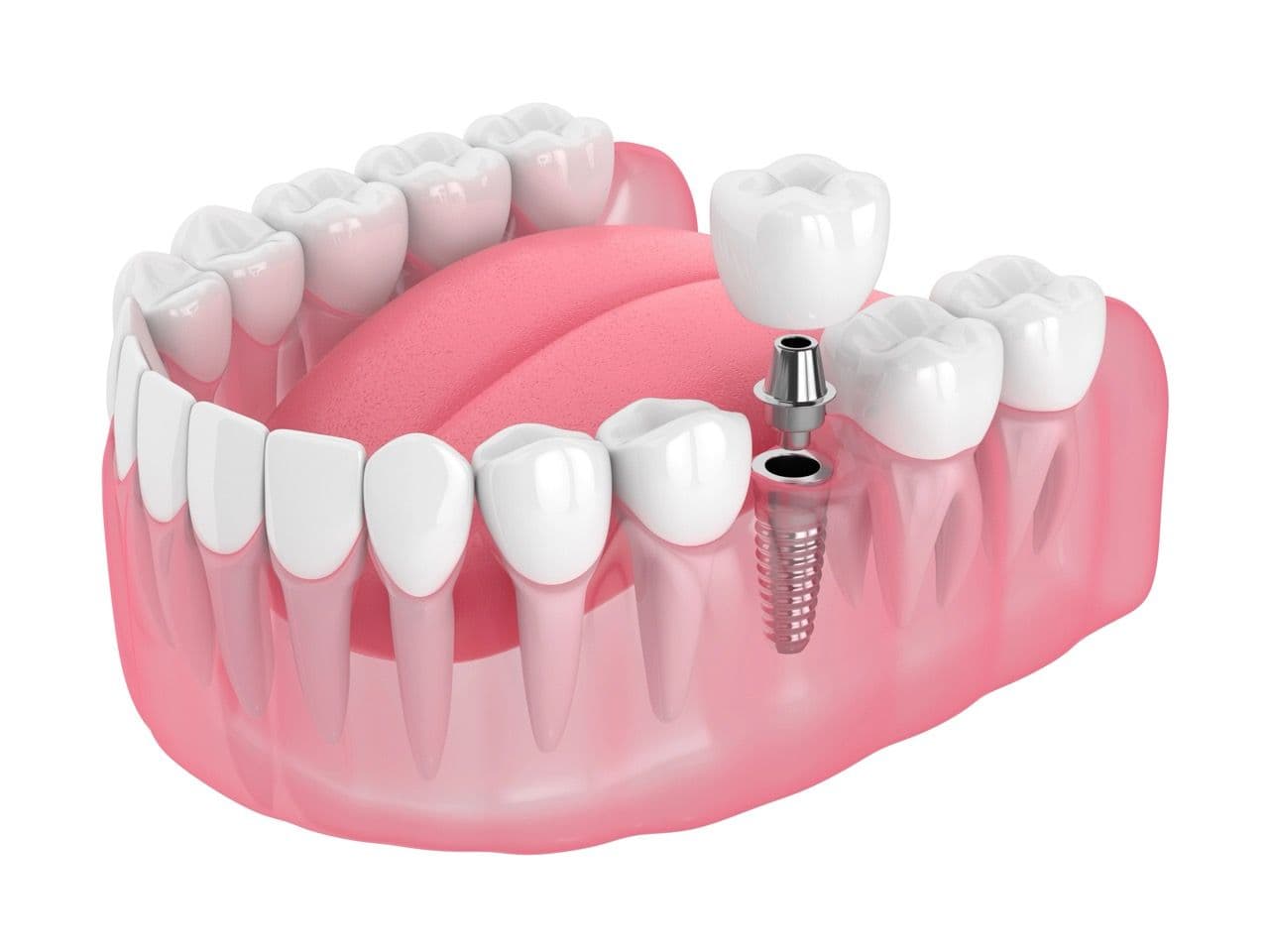 3D rendering of a lower haw with an implant and crown being placed