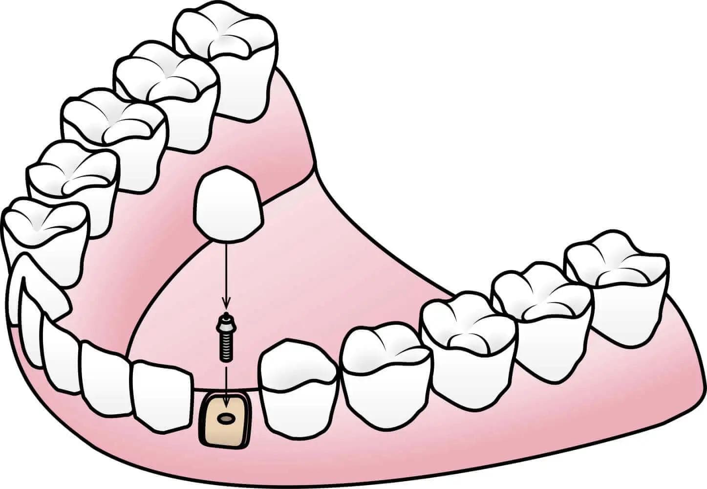 Illustration of endosteal dental implants