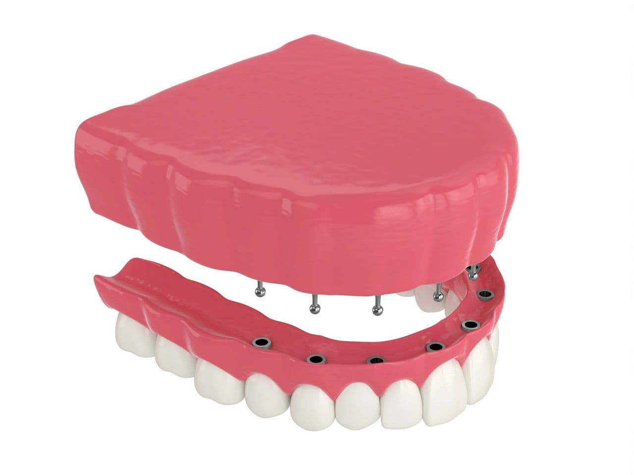 3D render of gums with implants and a snap-in denture ready to be placed