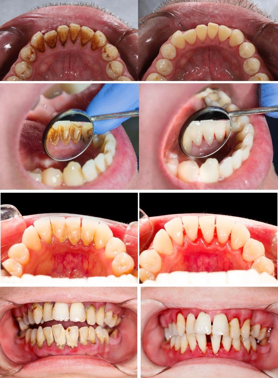 Four pictures each of two mouths should before and after deep cleaning